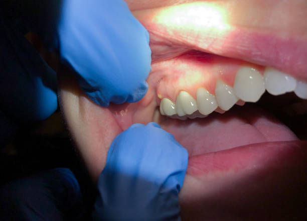 Best Emergency Wisdom Teeth Removal in Ralls, TX