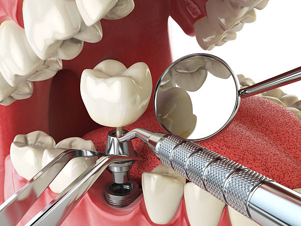 Best Emergency Tooth Extraction in Ralls, TX